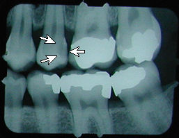 x-ray cavity