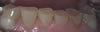 Worn Teeth